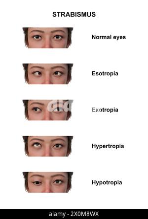 Illustration einer Frau mit verschiedenen Schielarten: Esotropie, Exotropie, Hypertropie und Hypotropie. Stockfoto