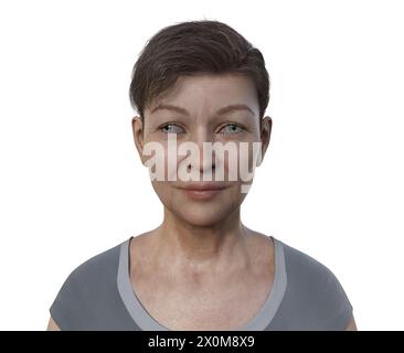 Illustration einer Exotropie-Frau mit Augenfehlstellung nach außen. Stockfoto