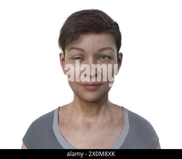 Illustration einer Frau mit Ptosis, einem Zustand hängender Augenlider, der das Sehen und die Gesichtsästhetik beeinflusst. Stockfoto