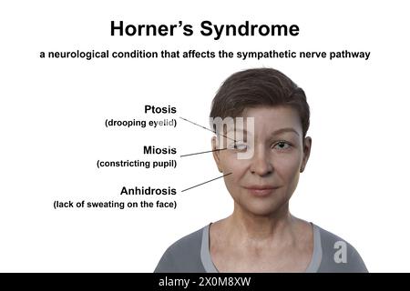 Illustration einer Frau mit Horner-Syndrom, Darstellung von Ptosis und Miosis durch sympathische Nervenstörung. Stockfoto