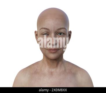 Illustration einer Frau mit Horner-Syndrom, Darstellung von Ptosis und Miosis durch sympathische Nervenstörung. Stockfoto