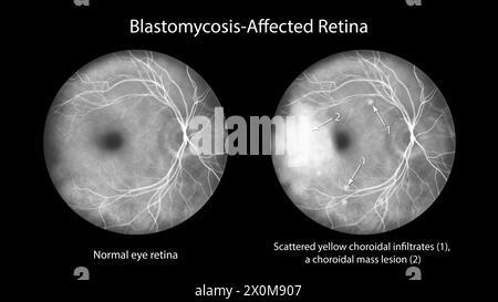 Darstellung einer blastomykosebefallenen Netzhaut am Beispiel der Fluoreszeinangiographie. Dies ist eine Infektion, die durch Blastomyces dermatitidis-Pilze verursacht wird. Die Netzhaut weist verstreute Aderhautinfiltrate und eine Massenläsion mit Farbstoffverlust auf. Stockfoto