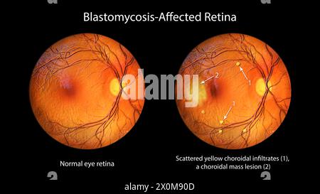 Darstellung einer blastomykosebefallenen Netzhaut aus der Ophthalmoskopie. Dies ist eine Infektion, die durch Blastomyces dermatitidis-Pilze verursacht wird. Die Netzhaut weist verstreute gelbe Aderhautinfiltrate und eine Aderhautläsion auf. Stockfoto