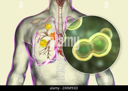 3D-Darstellung der pulmonalen Blastomykose und Nahaufnahme des Erreger-Pilzes Blastomyces dermatitidis. Blastomykose ist oft asymptomatisch, kann aber Lungenläsionen (gelb) und vergrößerte bronchiale Lymphknoten (orange) verursachen. Stockfoto