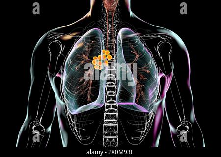 3D-Darstellung von Lungen mit mediastinaler Lymphadenopathie. Dies ist eine Vergrößerung der Lymphknoten innerhalb der zentralen Thoraxhöhle. Es gibt mehrere mögliche Ursachen für mediastinale Lymphadenopathie, einschließlich bakterieller Infektionen, Krebs und genetischer Erkrankungen. Stockfoto