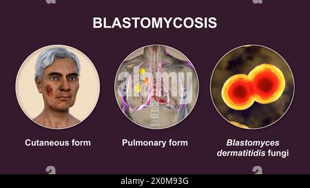 3D-Illustration mit zwei klinischen Darstellungen der Blastomykose und einer Nahaufnahme von Blastomyces dermatitidis-Pilzen. Blastomykose ist eine Pilzinfektion, die auftreten kann, wenn Blastomyces dermatitidis Sporen inhaliert werden. Infektionen betreffen vor allem die Lunge (Lunge), wobei einige Patienten auch Hautsymptome (kutane) wie Läsionen entwickeln. Stockfoto