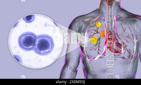 3D-Darstellung der pulmonalen Blastomykose und Nahaufnahme des Erreger-Pilzes Blastomyces dermatitidis. Blastomykose ist oft asymptomatisch, kann aber Lungenläsionen (gelb) und vergrößerte bronchiale Lymphknoten (orange) verursachen. Stockfoto