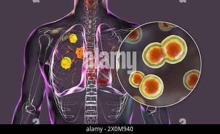 3D-Darstellung der pulmonalen Blastomykose und Nahaufnahme des Erreger-Pilzes Blastomyces dermatitidis. Blastomykose ist oft asymptomatisch, kann aber Lungenläsionen (gelb) und vergrößerte bronchiale Lymphknoten (orange) verursachen. Stockfoto