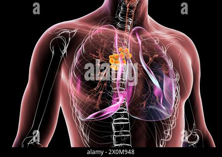 3D-Darstellung von Lungen mit mediastinaler Lymphadenopathie. Dies ist eine Vergrößerung der Lymphknoten innerhalb der zentralen Thoraxhöhle. Es gibt mehrere mögliche Ursachen für mediastinale Lymphadenopathie, einschließlich bakterieller Infektionen, Krebs und genetischer Erkrankungen. Stockfoto