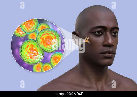 3D-Illustration eines Mannes mit einer Infektion des Mittelohrs (Otitis Media) und einer Nahaufnahme von Moraxella catarrhalis-Bakterien, die diese Infektion verursachen können. Zu den Symptomen gehören Entzündungen, Flüssigkeitsansammlungen und Schmerzen im Ohr. Stockfoto