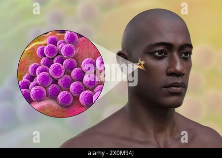 3D-Illustration eines Mannes mit einer bakteriellen Mittelohrinfektion (Otitis Media) und einer Nahaufnahme des verursachenden Bakteriums Staphylococcus aureus. Zu den Symptomen gehören Entzündungen, Flüssigkeitsansammlungen und Schmerzen im Ohr. Stockfoto