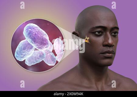 3D-Illustration eines Mannes mit einer Infektion des Mittelohrs (Otitis Media) und einer Nahaufnahme von Haemophilus influenzae Bakterien, die diese Infektion verursachen können. Zu den Symptomen gehören Entzündungen, Flüssigkeitsansammlungen und Schmerzen im Ohr. Stockfoto