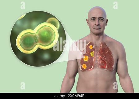 3D-Darstellung der pulmonalen Blastomykose und Nahaufnahme des Erreger-Pilzes Blastomyces dermatitidis. Blastomykose ist oft asymptomatisch, kann aber Lungenläsionen (orange) und vergrößerte bronchiale Lymphknoten (gelb) verursachen. Stockfoto