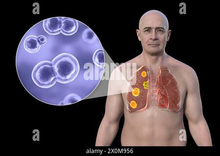 3D-Darstellung der pulmonalen Blastomykose und Nahaufnahme des Erreger-Pilzes Blastomyces dermatitidis. Blastomykose ist oft asymptomatisch, kann aber Lungenläsionen (orange) und vergrößerte bronchiale Lymphknoten (gelb) verursachen. Stockfoto
