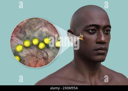 3D-Darstellung eines Mannes mit einer bakteriellen Mittelohrinfektion (Otitis Media) und einer Nahaufnahme der verursachenden Bakterien. Zu den Symptomen gehören Entzündungen, Flüssigkeitsansammlungen und Schmerzen im Ohr. Stockfoto