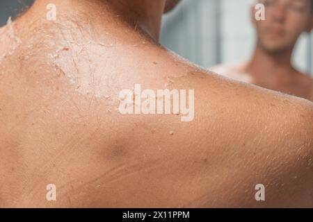 Peeling der Haut nach Sonnenbrand. Mann mit Haut, die sich ablöst, verbrannte Haut. Nahaufnahme Stockfoto