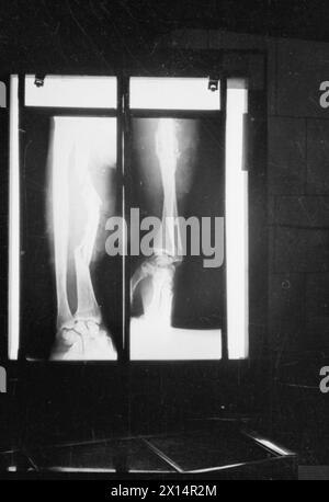 Eine Röntgenaufnahme von 1941 im Guy's Hospital, London, zeigt einen gebrochenen Arm eines Mannes, der ihn benutzt hat, um seinen Kopf vor herabfallendem Mauerwerk zu schützen. Stockfoto