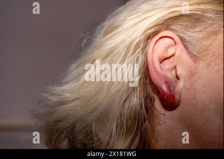 Entzündetes und blutiges Ohrläppchen nach Ohrpiercing Stockfoto