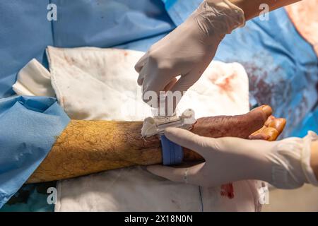 Die Pflegekraft schließt den Gefäßzugang des Patienten nach der Operation. Eine Krankenschwester legt im OP Gefäßverbände an. Medizinische Behandlung zu halten Stockfoto