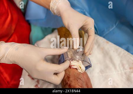 Die Pflegekraft schließt den Gefäßzugang des Patienten nach der Operation. Eine Krankenschwester legt im OP Gefäßverbände an. Medizinische Behandlung zu halten Stockfoto