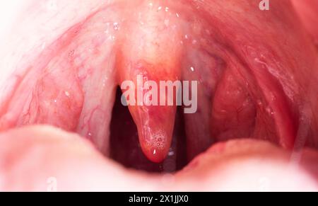 Rote, entzündete und geschwollene Uvula im Hals. Behandlung der Uvulitis durch Bakterien und Streptokokkenviren. Hno-Heilkunde Stockfoto