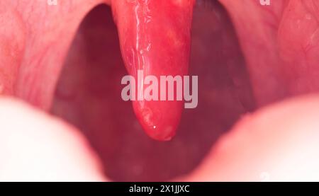 Rote, entzündete und geschwollene Uvula im Hals. Behandlung der Uvulitis durch Bakterien und Streptokokkenviren. Hno-Heilkunde Stockfoto