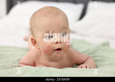 Niedliches kleines Baby mit allergischer Rötung auf den Wangen, das zu Hause auf dem Bett liegt Stockfoto