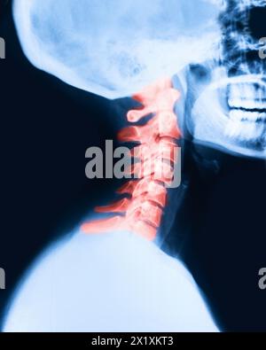 Nahaufnahme der Röntgenaufnahme des schmerzhaften Bereichs der Halswirbelsäule Stockfoto