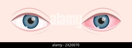 Gesundes und krankes menschliches Sehorgan. Trockenes Auge-Syndrom. Entzündeter Augapfel mit Reizung und roter Bindehaut. Symptome von Keratitis, Blepharitis, Konjunktivitis oder Uveitis. Illustration der Vektorabwicklung. Stock Vektor