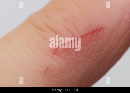 Ein heilender Kratzer am Finger eines Mannes. Stockfoto