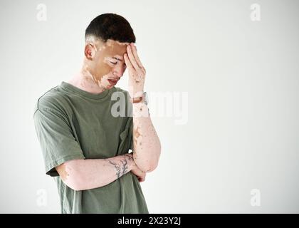 Traurig, Angst und Mann in Depressionen mit Kopfschmerzen und Sorge um Vitiligo auf der Haut im Studio-Hintergrund. Psychische Gesundheit, Krise oder einzigartige Dermatologie Stockfoto