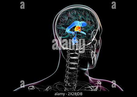 Die Vergrößerung des dritten Hirnventrikels, Illustration Stockfoto