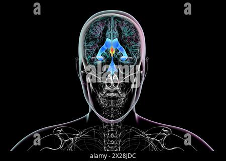 Die Vergrößerung des dritten Hirnventrikels, Illustration Stockfoto