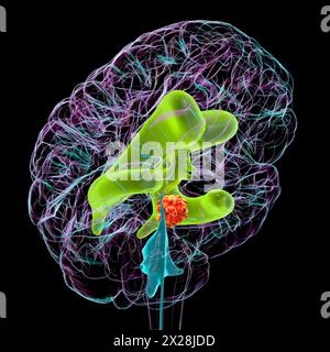 Hirntumor, der Hydrozephalus verursacht, Illustration Stockfoto