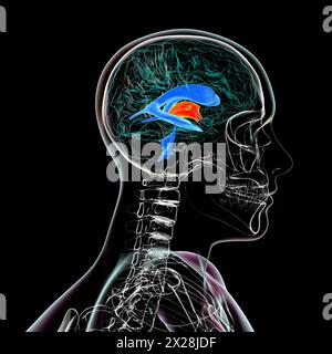 Die Vergrößerung des dritten Hirnventrikels, Illustration Stockfoto