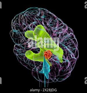 Hirntumor, der Hydrozephalus verursacht, Illustration Stockfoto