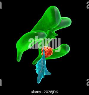 Hirntumor, der Hydrozephalus verursacht, Illustration Stockfoto