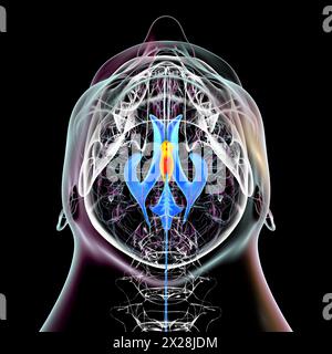 Die Vergrößerung des dritten Hirnventrikels, Illustration Stockfoto