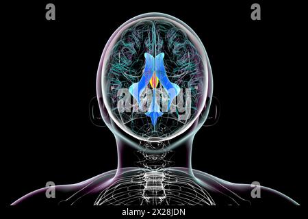 Die Vergrößerung des dritten Hirnventrikels, Illustration Stockfoto
