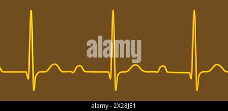 EKG mit AV-Block ersten Grades, Abbildung Stockfoto