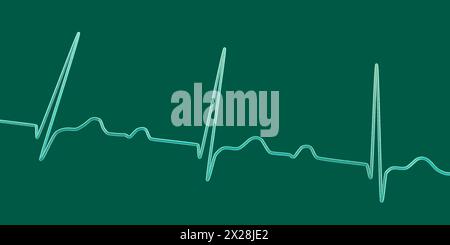 EKG mit AV-Block ersten Grades, Abbildung Stockfoto