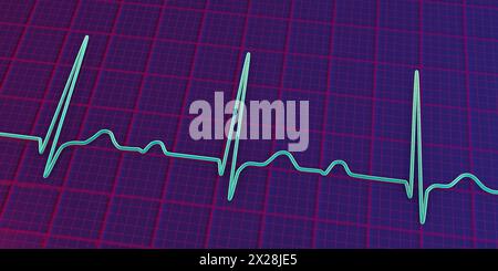 EKG mit AV-Block ersten Grades, Abbildung Stockfoto