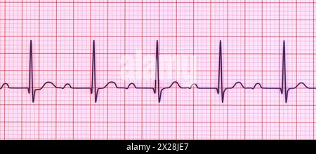 EKG mit AV-Block ersten Grades, Abbildung Stockfoto