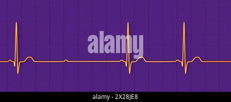 EKG mit Mobitz 2 AV-Block zweiten Grades, Abbildung Stockfoto