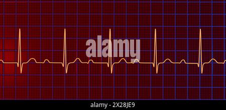 EKG mit AV-Block ersten Grades, Abbildung Stockfoto