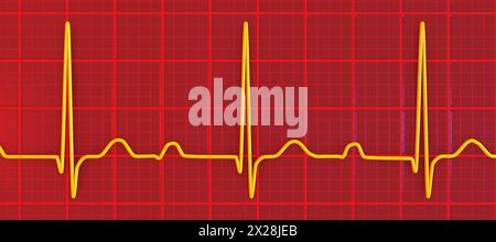 EKG mit AV-Block ersten Grades, Abbildung Stockfoto