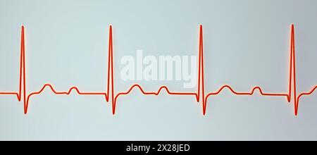 EKG mit AV-Block ersten Grades, Abbildung Stockfoto