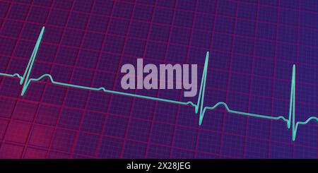 EKG mit Mobitz 2 AV-Block zweiten Grades, Abbildung Stockfoto