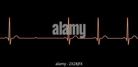 EKG mit Mobitz 2 AV-Block zweiten Grades, Abbildung Stockfoto