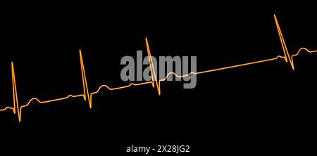 EKG mit AV-Block 2. Grades, Abbildung Stockfoto